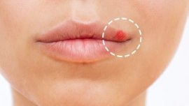 Трикове за успокояване на херпеса