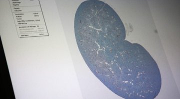 Хронична бъбречна недостатъчност - с повишение сред населението