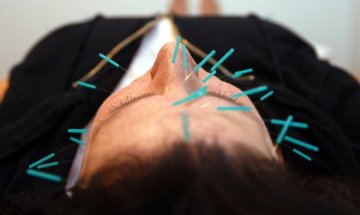 Акупунктура – кога си струва да я изтърпим?