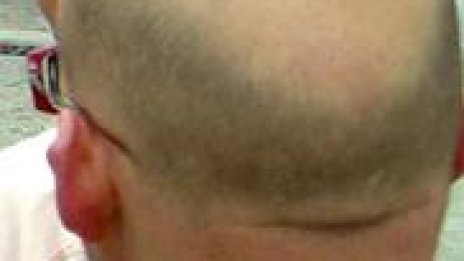 Робот ще бори плешивостта