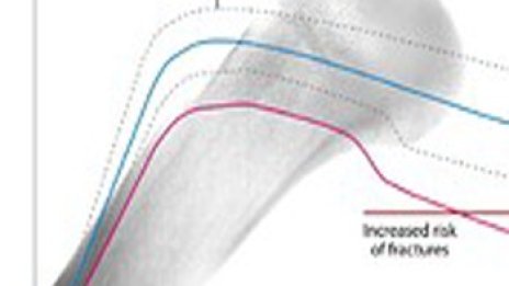 Депресията води до остеопороза