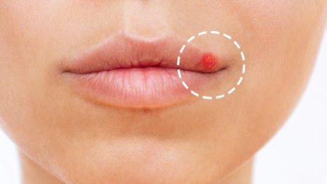 Трикове за успокояване на херпеса