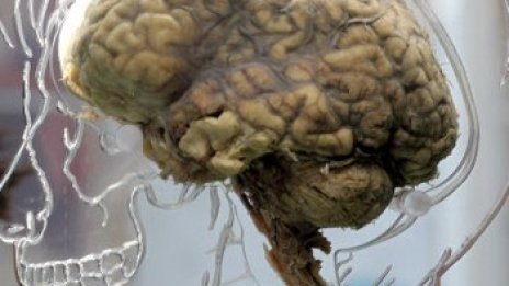 Протеин в мозъчните клетки &ndash; от ключово значение за аутизъм