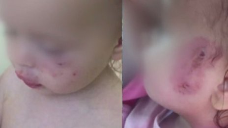 Дете бе зверски нахапано в ясла, от там – "лек инцидент"