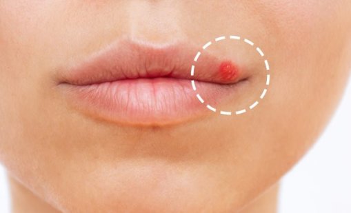 Трикове за успокояване на херпеса
