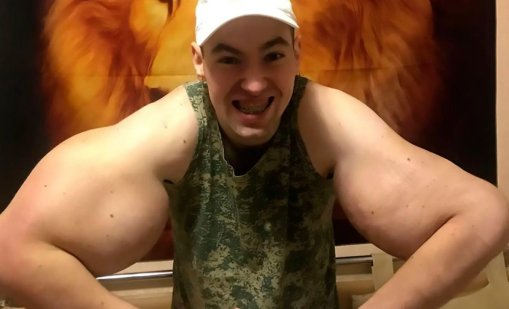 "Руският Попай", който си инжектира вазелин в бицепсите, може да загуби ръцете си 