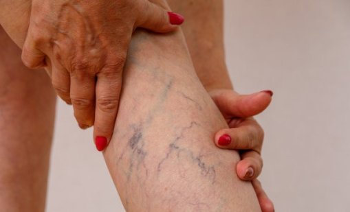 3 рецепти при разширени вени