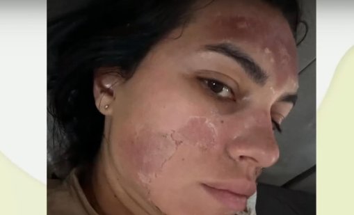 "Козметичка" обезобрази млада майка с "билков пилинг" в хол