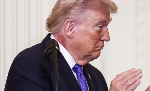 Пак се притесниха за здравето на Тръмп: Появи се с огромна рана на врата