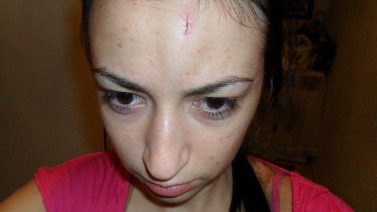 Студентката Ширин Мустафова с пукнатина на челото. Снимка: БГНЕС