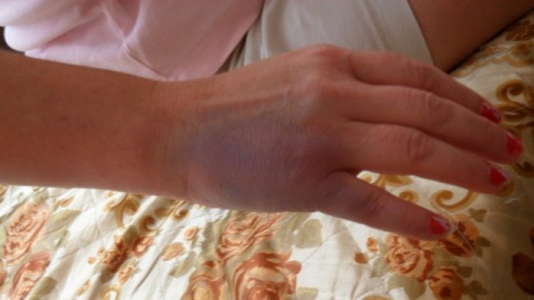 Синина по ръката на Айсел Мустафова след полицейската акция. Снимка: БГНЕС