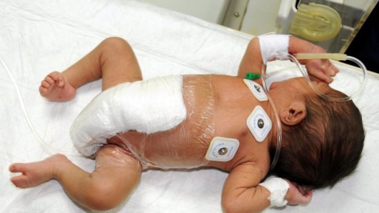 Малкото момченце е в стабилно състояние след операцията. Снимка: БТА