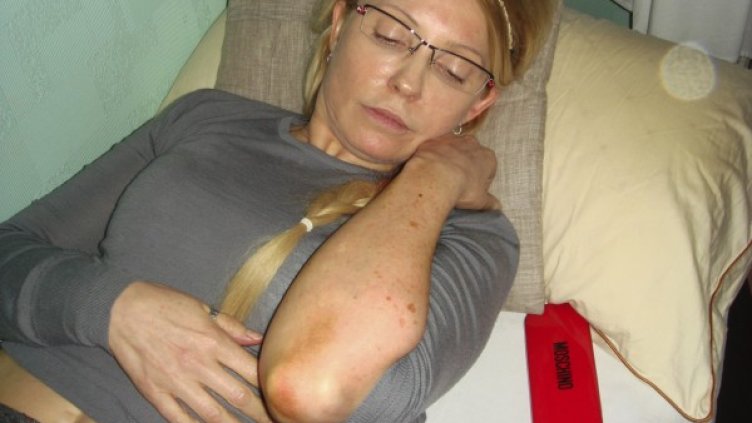 Тимошенко показва белезите си. Снимка: Reuters