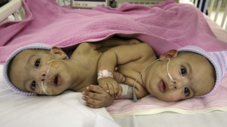 Сиамски близнаци се появяват средно на 100 хиляди раждания. Снимка: Reuters
