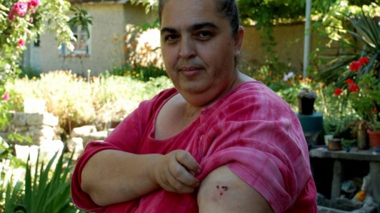 Пострадалата жена покачва част от раните си. Снимка: Impact Press Group