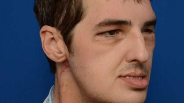 Нов живот с ново лице след 114 дни 