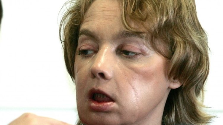 Снимка: архив, Reuters
Непосредствено след операцията Снимка: Reuters
Една година след трансплантацията Снимка: Getty Images/Guliver Photos