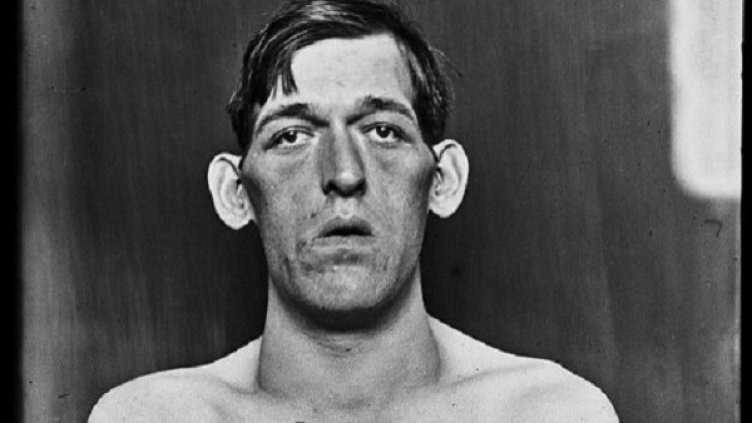 Клъцни тук, срежи там – първите пациенти с мозъчни операции