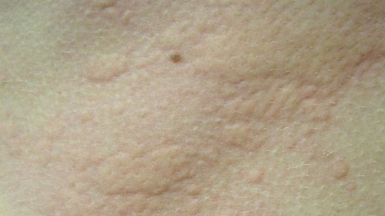 Край на хранителните алергии?