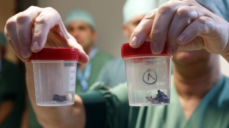 Хирург показва шрапнели, извадени от жертви от Брюксел. Снимка: Reuters