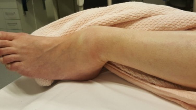 Счупеният глезен на мъжа