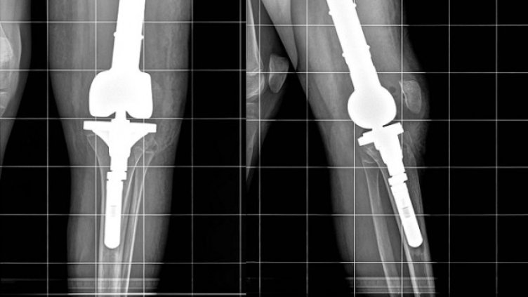 Снимка: Университетската болница по ортопедия