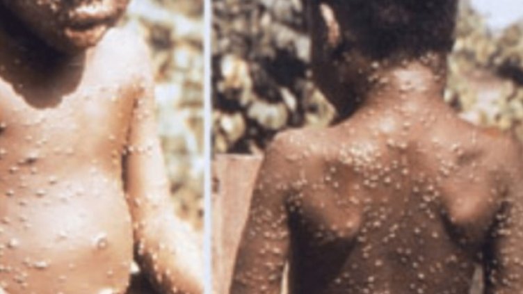 Снимка:НЦЗПБ