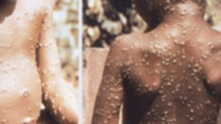 Снимка: НЦЗПБ