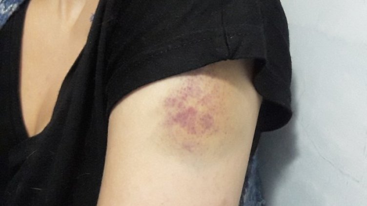 Димитрова разпространи снимки със следи от насилие, за които твърди, че са нанесени от Вергов. Снимка: Facebook