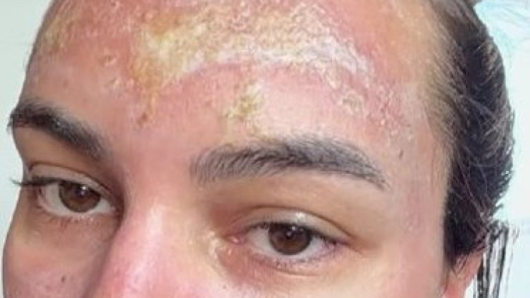 Салонът, в който жена получи втора степен изгаряния от пилинт, остана без регистрация