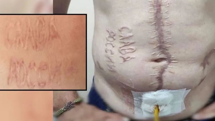 Лекари се борят надписът "Слава на Русия", издълбан в стомаха на украинец, да изчезне 