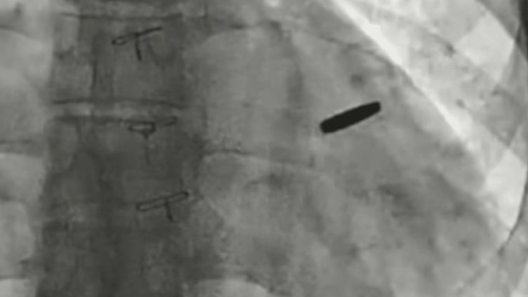 Войник, бранил "Азовстал", прекарал три години в руски плен с куршум в сърцето ВИДЕО