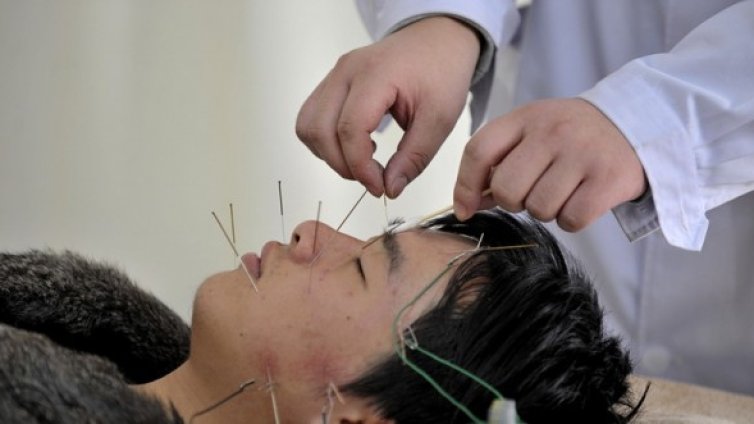 Учени доказаха, че акупунктурата действа обезболяващо