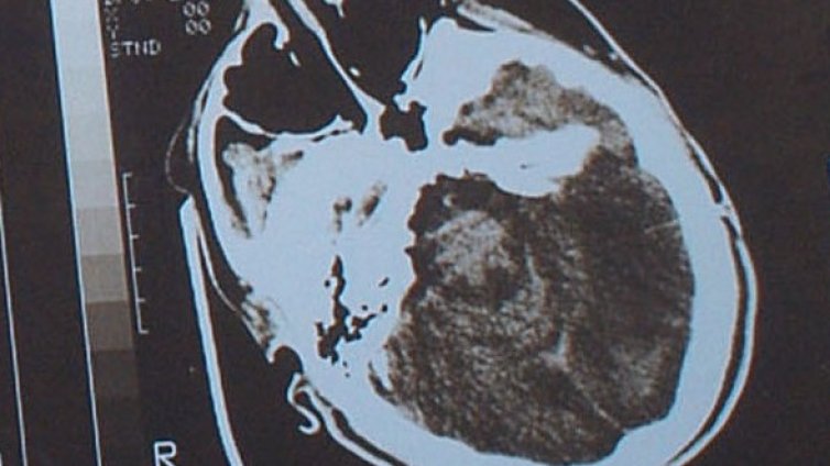 Разсеяните хора са с повече сиво вещество