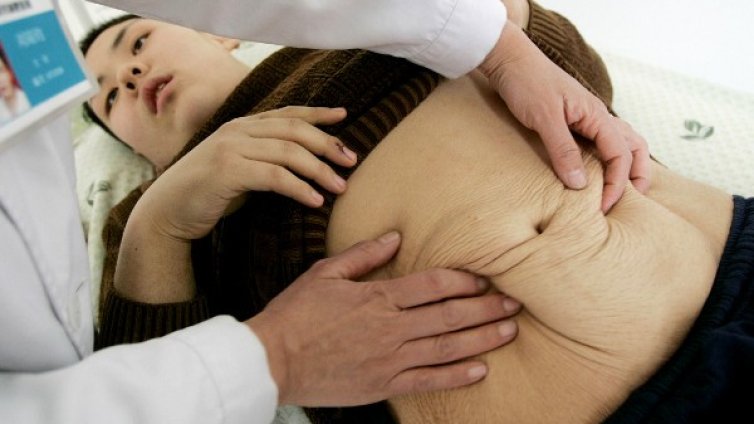 Синдромът на дразнимото черво &ndash; как да го познаем?