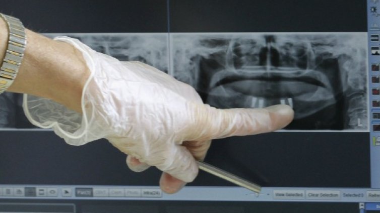 Старите пломби &ndash; вредни ли са?