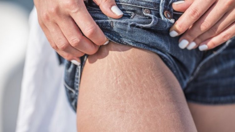 5 начина да намалите стриите по кожата