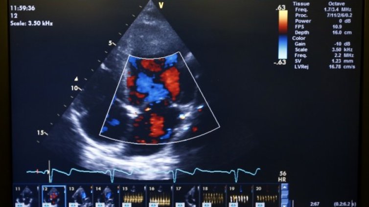 Причини за сърдечни проблеми при жените