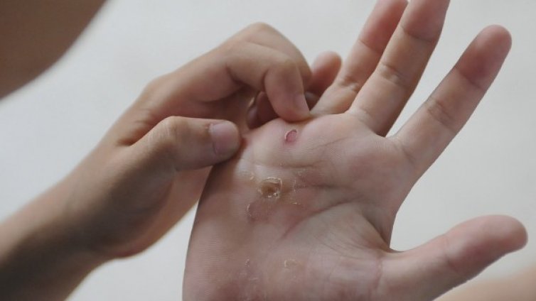 Мехури по кожата &ndash; първи мерки