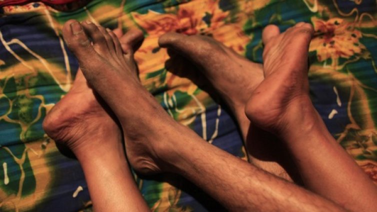 Най-често отоците на краката се дължат на болни вени