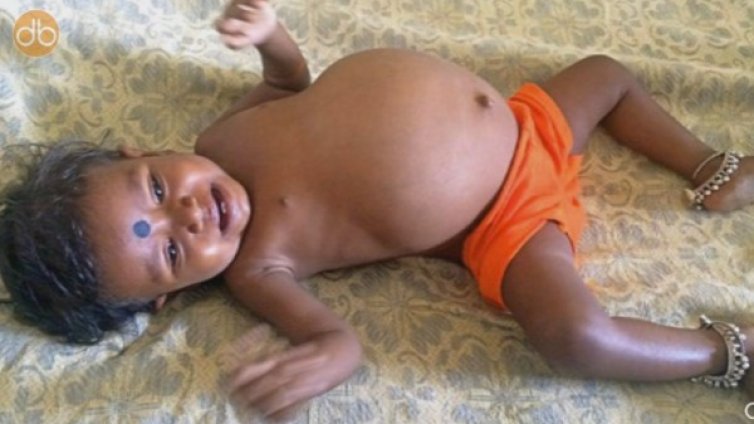 Феномен! Бебе на годинка носи собствения си близнак