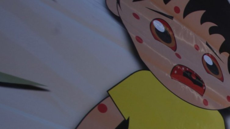 Болните от морбили станаха 11, но пък няма нови огнища