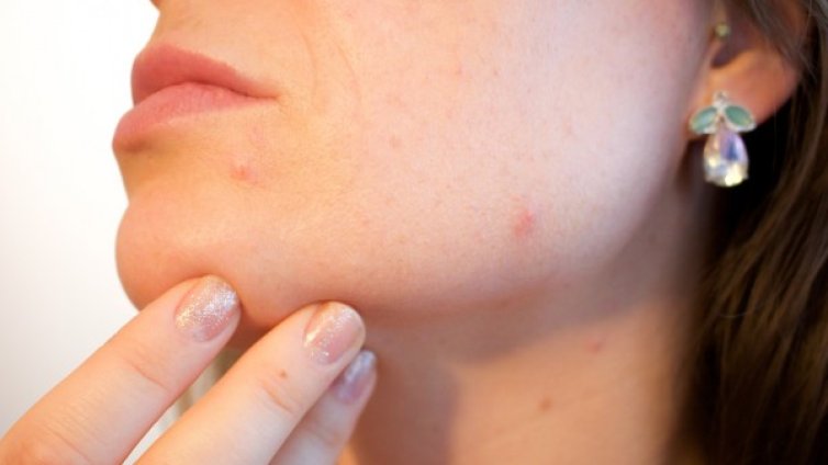 Поликистозни яйчници и акне &ndash; имат ли връзка?