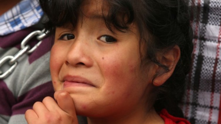 Алергична реакция &ndash; кои са първите симптоми?