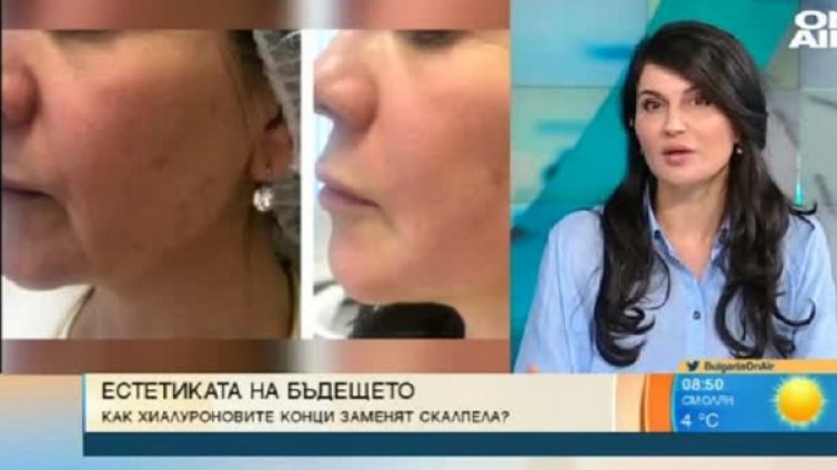 Хиалуроновите конци - най-силният съюзник на младостта