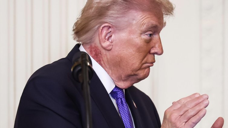 Тръмп е подложен на интензивно лечение заради обрива по врата