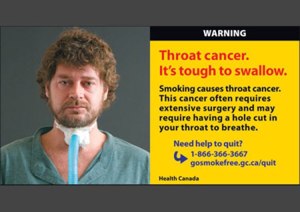 Пушенето предизвиква и рак на гърлото. Трудно е да преглъщаш. Този вид рак изисква сложна операция, след която най-често се налага да дишате чрез тръба в гърлото.
Изображение: hc-sc.gc.ca
