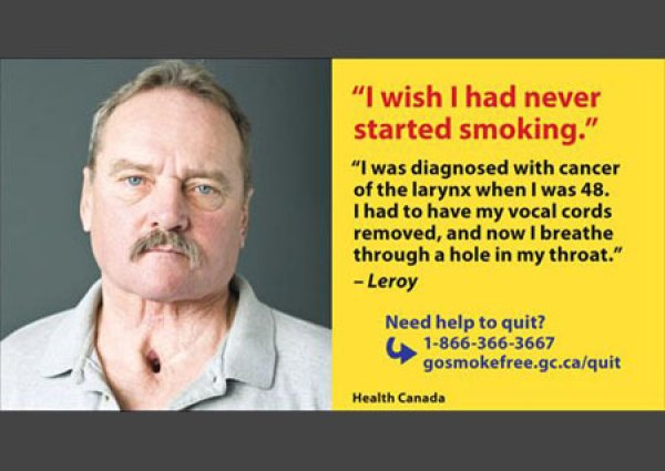 "Искаше ми се никога да не бях започвал да пуша. Поставиха ми диагнозата рак на гласните струни, когато бях на 48. Сега дишам през дупка в гърлото&ldquo;
Изображение: hc-sc.gc.ca